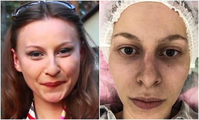 Снежана Камбур до и после пластики