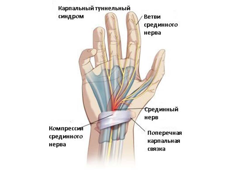 Нейропатическая причина синдрома Зудека.jpg Нейропатическая причина синдрома Зудека.jpg