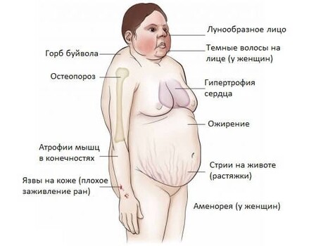 Основные симптомы болезни Иценко-Кушинга Фото при синдроме иценко кушинга