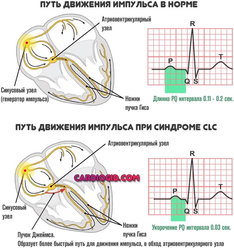Синдром CLC