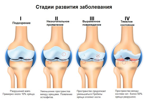 Стадии артроза суставов