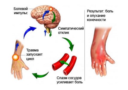 Порочный круг при синдроме Зудока.jpg Порочный круг при синдроме Зудока.jpg