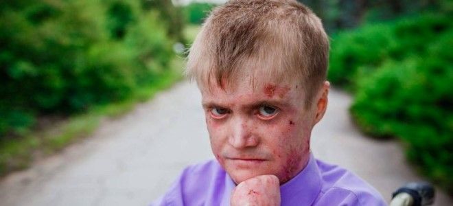 пограничный буллезный эпидермолиз пограничный буллезный эпидермолиз