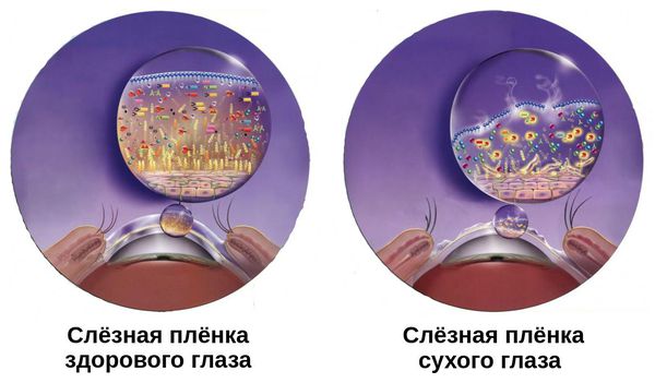 Изменение слёзной плёнки Изменение слёзной плёнки