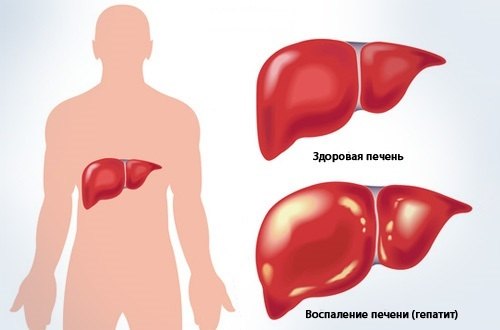 Печень при гепатите Печень при гепатите