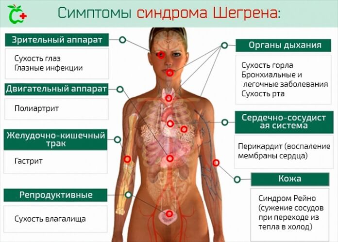 Синдром Шегрена Синдром Шегрена